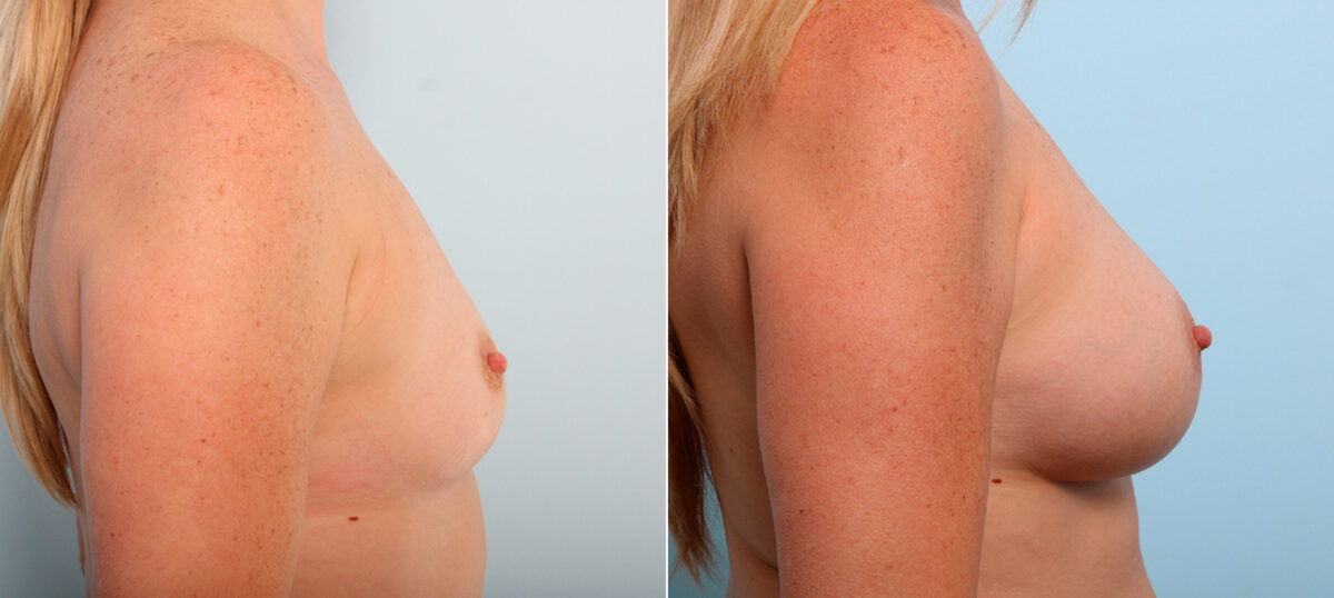 Breast Augmentation before and after photos in Houston, TX, Patient 41983