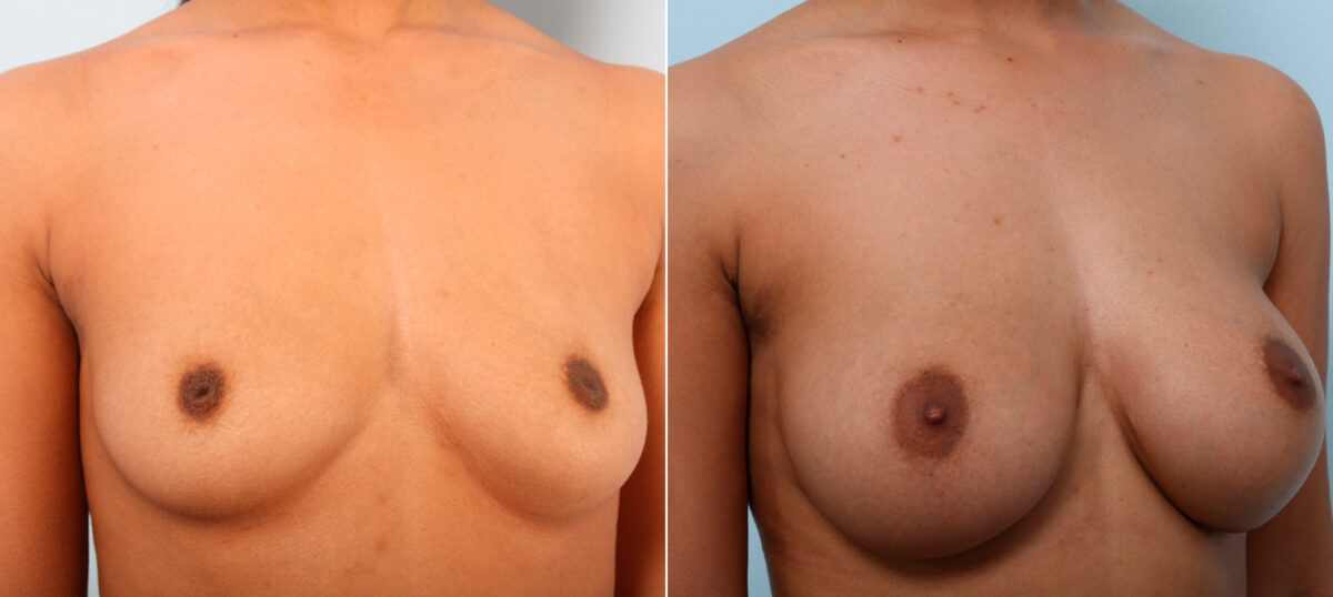 Breast Augmentation before and after photos in Houston, TX, Patient 42004