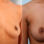 Breast Augmentation before and after photos in Houston, TX, Patient 42004