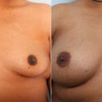 Breast Augmentation before and after photos in Houston, TX, Patient 42025