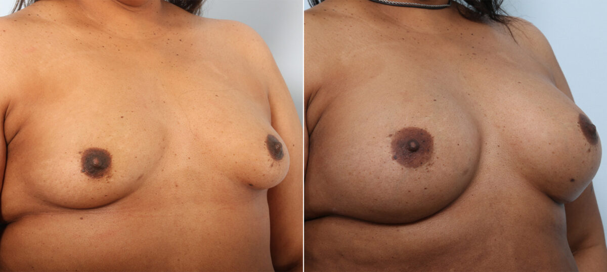 Breast Augmentation before and after photos in Houston, TX, Patient 42025