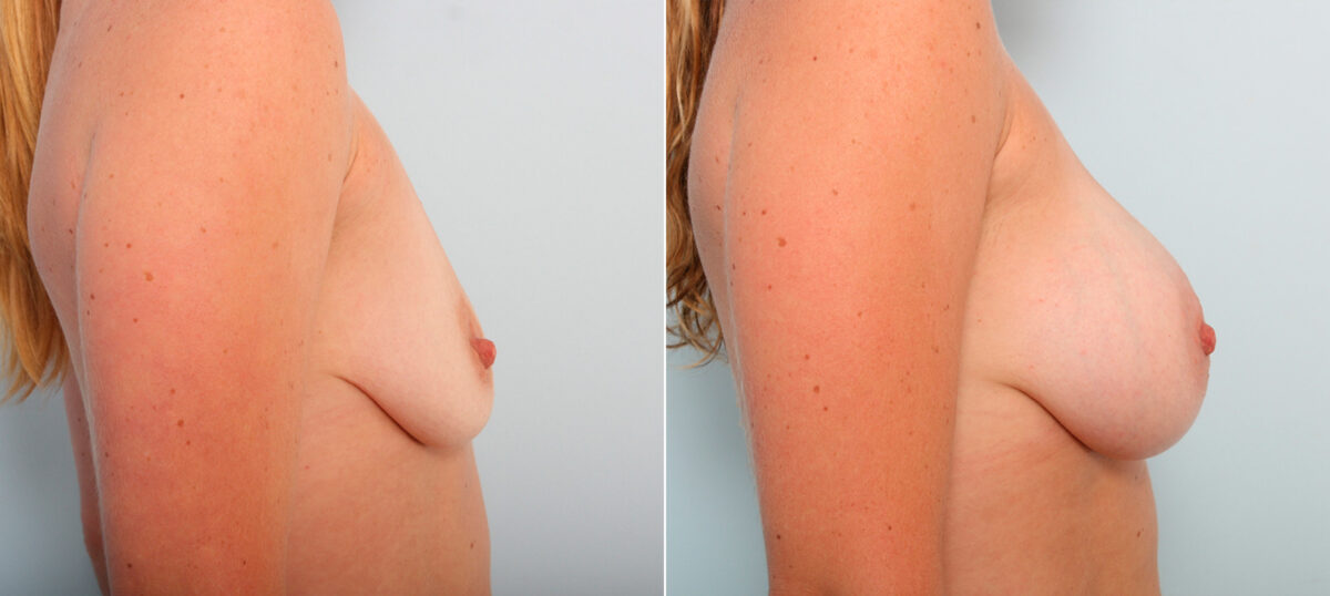 Breast Augmentation before and after photos in Houston, TX, Patient 42051