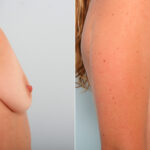 Breast Augmentation before and after photos in Houston, TX, Patient 42051