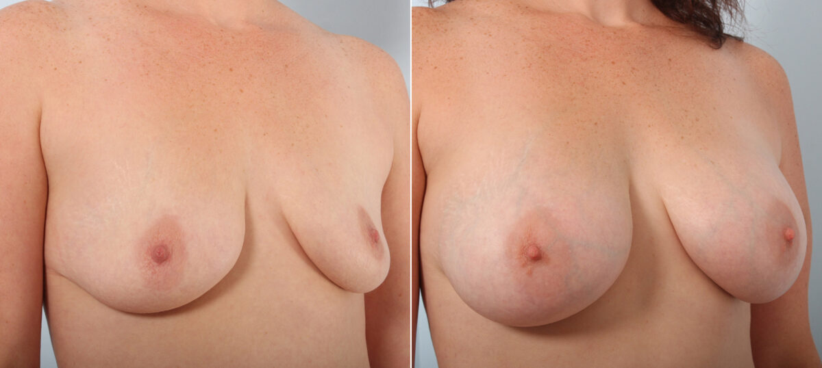 Breast Augmentation before and after photos in Houston, TX, Patient 42077