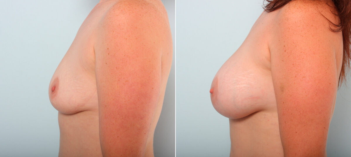 Breast Augmentation before and after photos in Houston, TX, Patient 42077