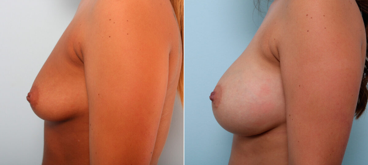 Breast Augmentation before and after photos in Houston, TX, Patient 42098
