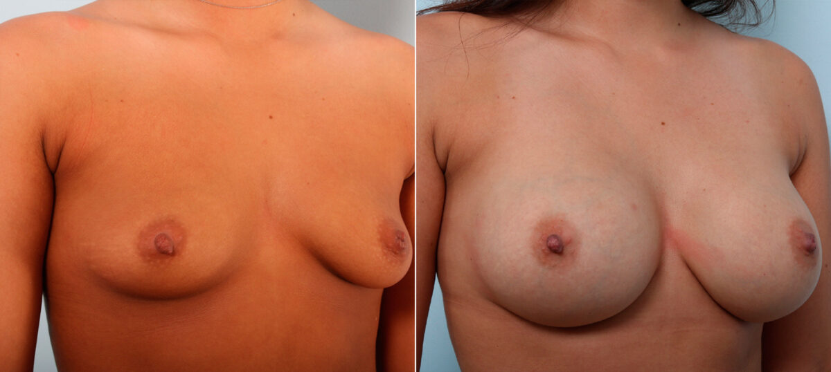 Breast Augmentation before and after photos in Houston, TX, Patient 42098