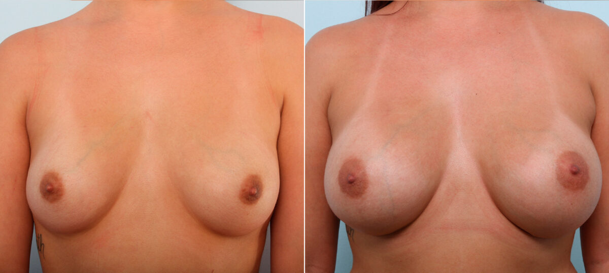 Breast Augmentation before and after photos in Houston, TX, Patient 42119