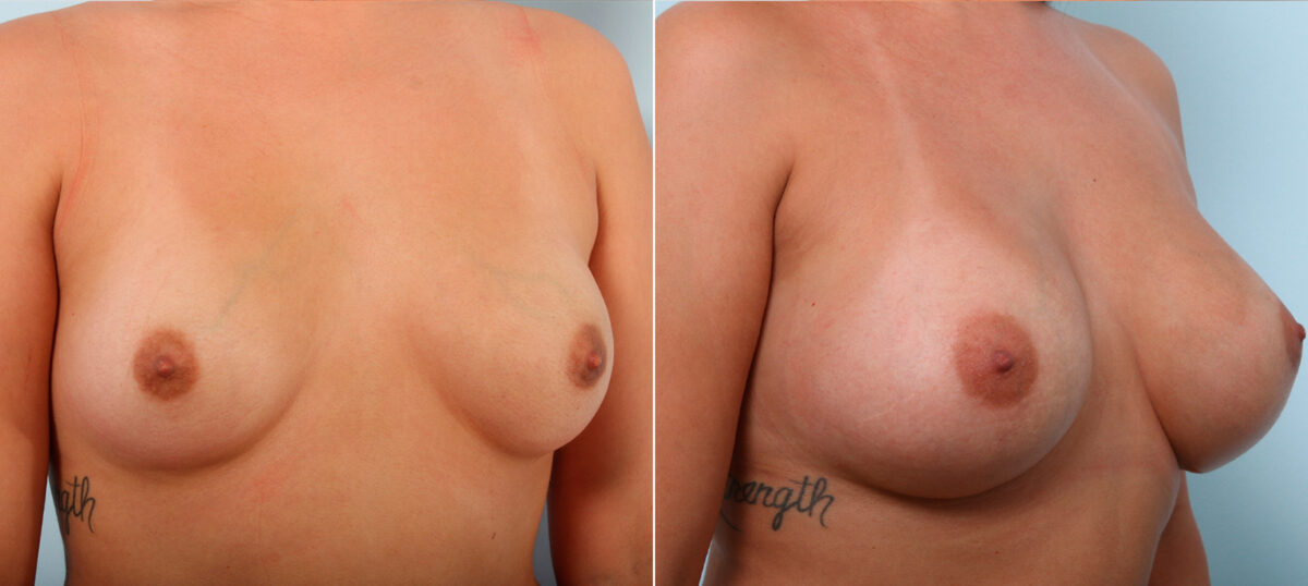Breast Augmentation before and after photos in Houston, TX, Patient 42119