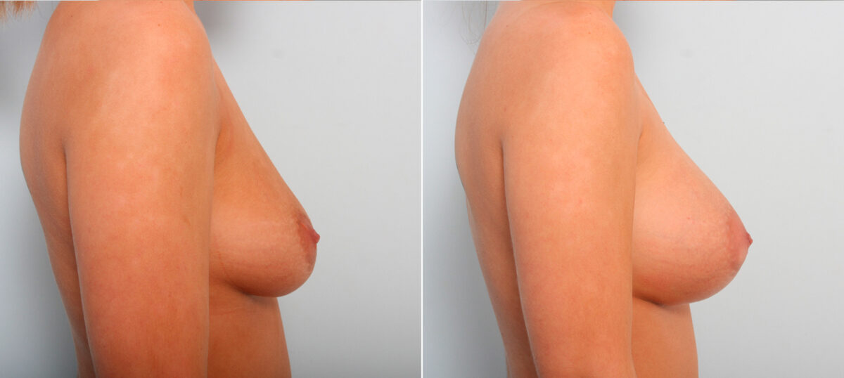 Breast Augmentation before and after photos in Houston, TX, Patient 42140