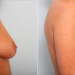 Breast Augmentation before and after photos in Houston, TX, Patient 42140