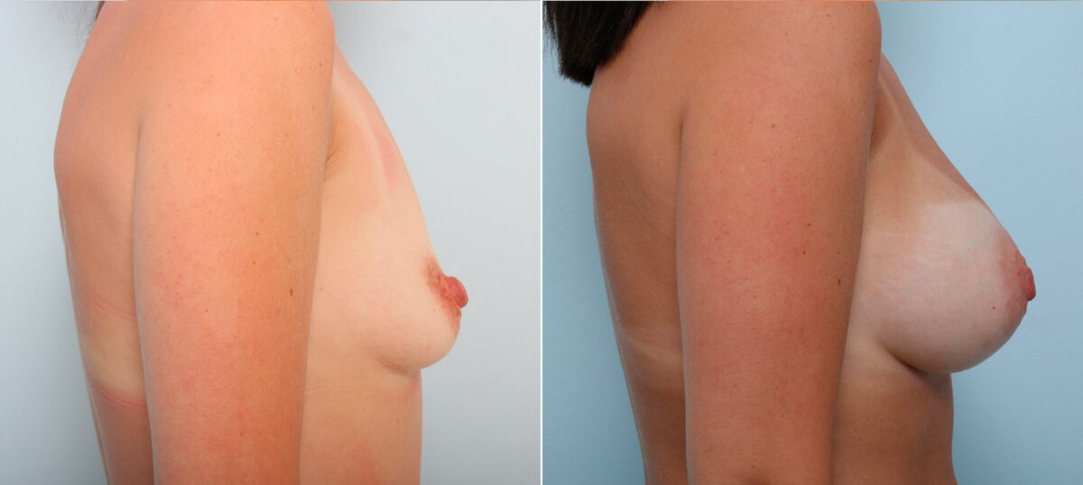 Breast Augmentation before and after photos in Houston, TX, Patient 42161
