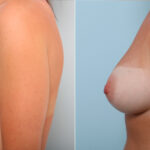 Breast Augmentation before and after photos in Houston, TX, Patient 42161