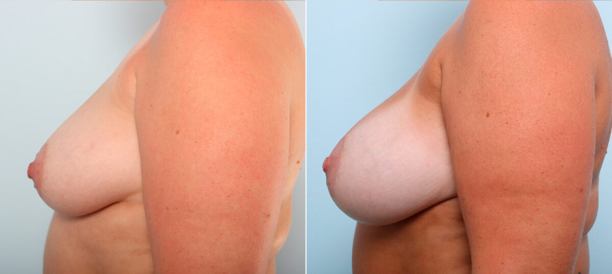 Breast Augmentation before and after photos in Houston, TX, Patient 42182