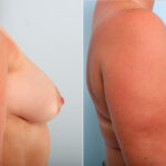 Breast Augmentation before and after photos in Houston, TX, Patient 42182