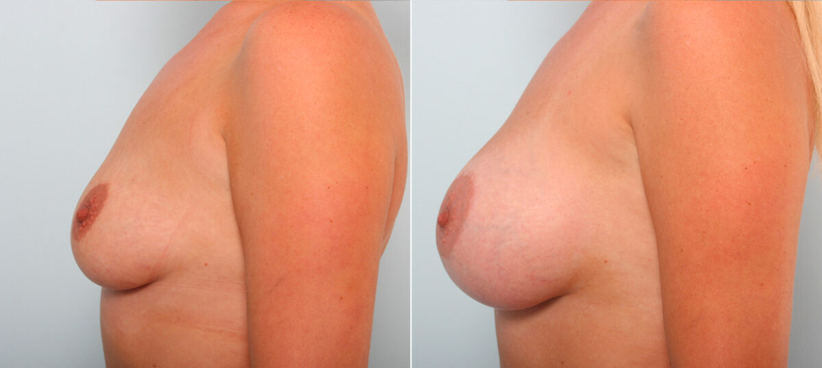 Breast Augmentation before and after photos in Houston, TX, Patient 42203