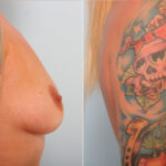 Breast Augmentation before and after photos in Houston, TX, Patient 42203