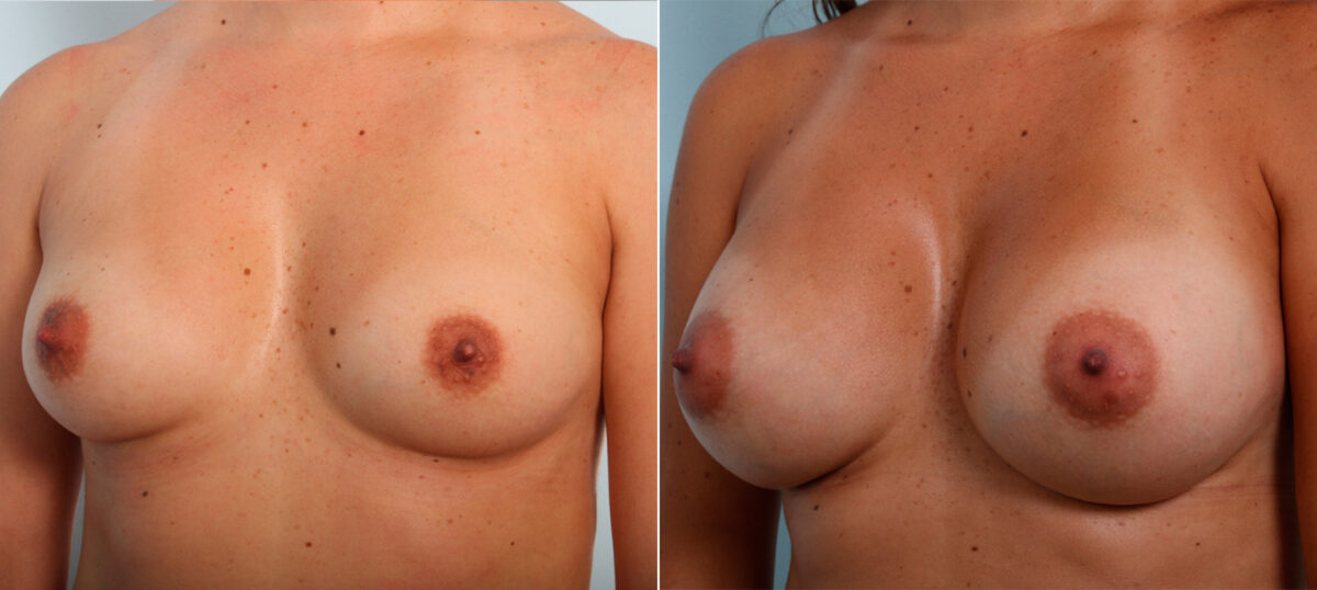 Breast Augmentation before and after photos in Houston, TX, Patient 42224
