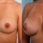 Breast Augmentation before and after photos in Houston, TX, Patient 42224