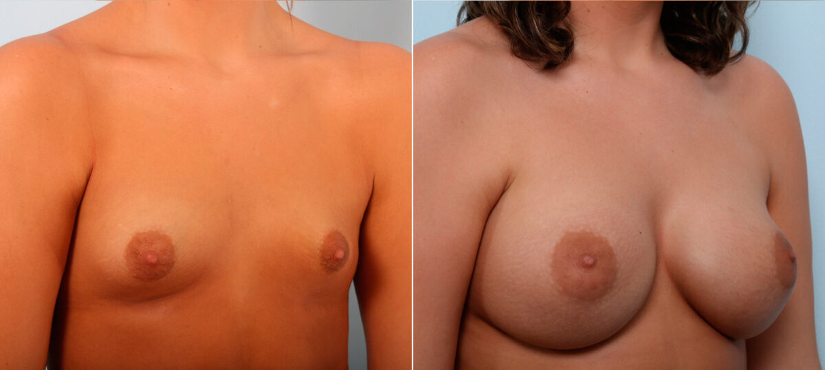 Breast Augmentation before and after photos in Houston, TX, Patient 42245