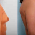 Breast Augmentation before and after photos in Houston, TX, Patient 42245