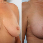 Breast Augmentation before and after photos in Houston, TX, Patient 42266