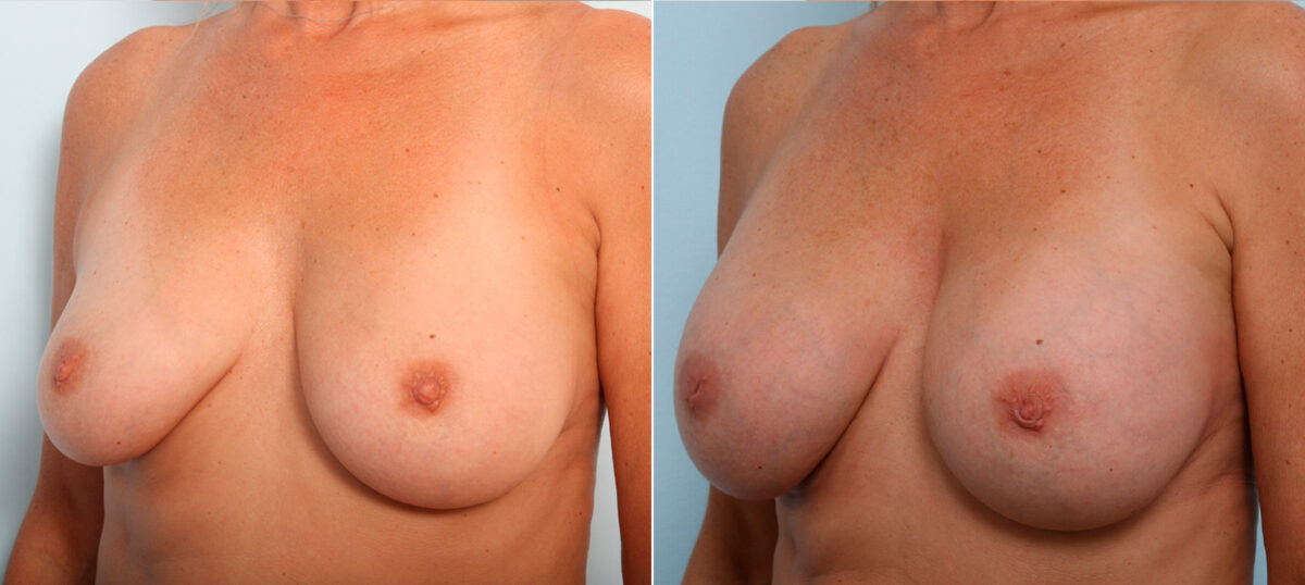 Breast Augmentation before and after photos in Houston, TX, Patient 42266