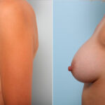 Breast Augmentation before and after photos in Houston, TX, Patient 42287