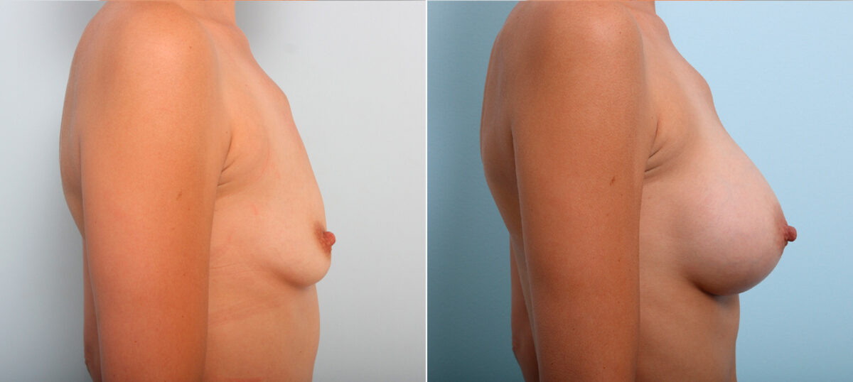 Breast Augmentation before and after photos in Houston, TX, Patient 42287