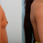 Breast Augmentation before and after photos in Houston, TX, Patient 42308
