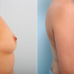 Breast Augmentation before and after photos in Houston, TX, Patient 42329