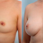 Breast Augmentation before and after photos in Houston, TX, Patient 42329