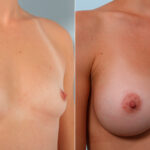 Breast Augmentation before and after photos in Houston, TX, Patient 42350