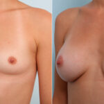 Breast Augmentation before and after photos in Houston, TX, Patient 42350