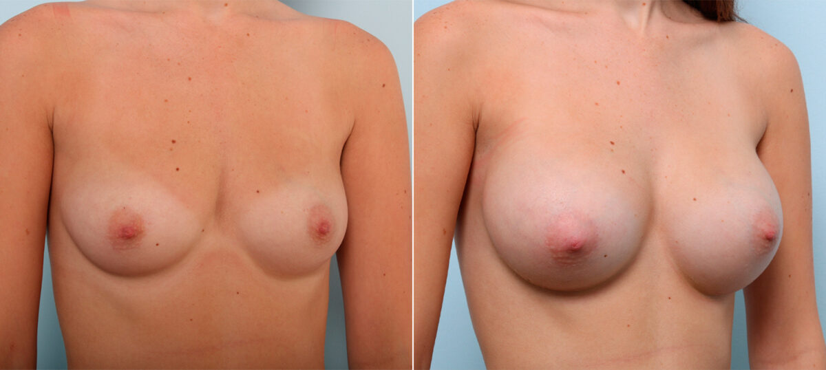 Breast Augmentation before and after photos in Houston, TX, Patient 42371