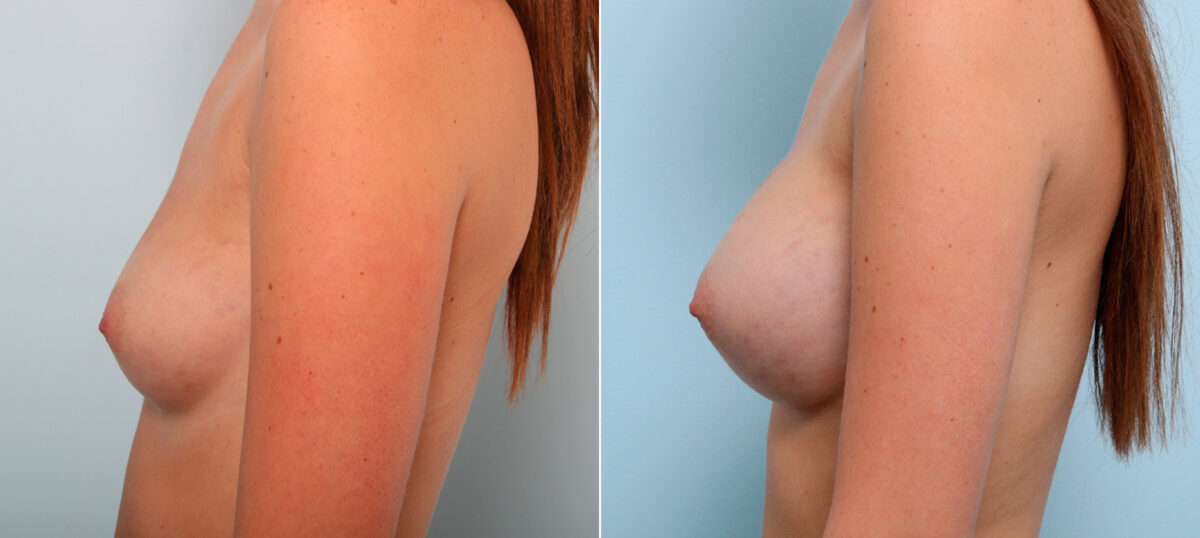 Breast Augmentation before and after photos in Houston, TX, Patient 42371
