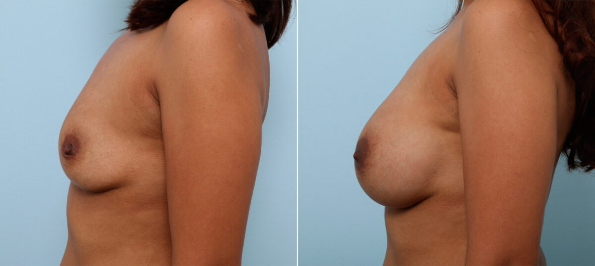 Breast Augmentation before and after photos in Houston, TX, Patient 42392