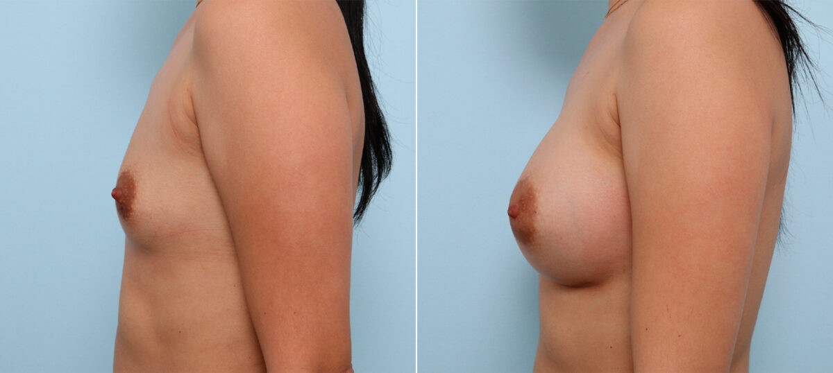 Breast Augmentation before and after photos in Houston, TX, Patient 42413