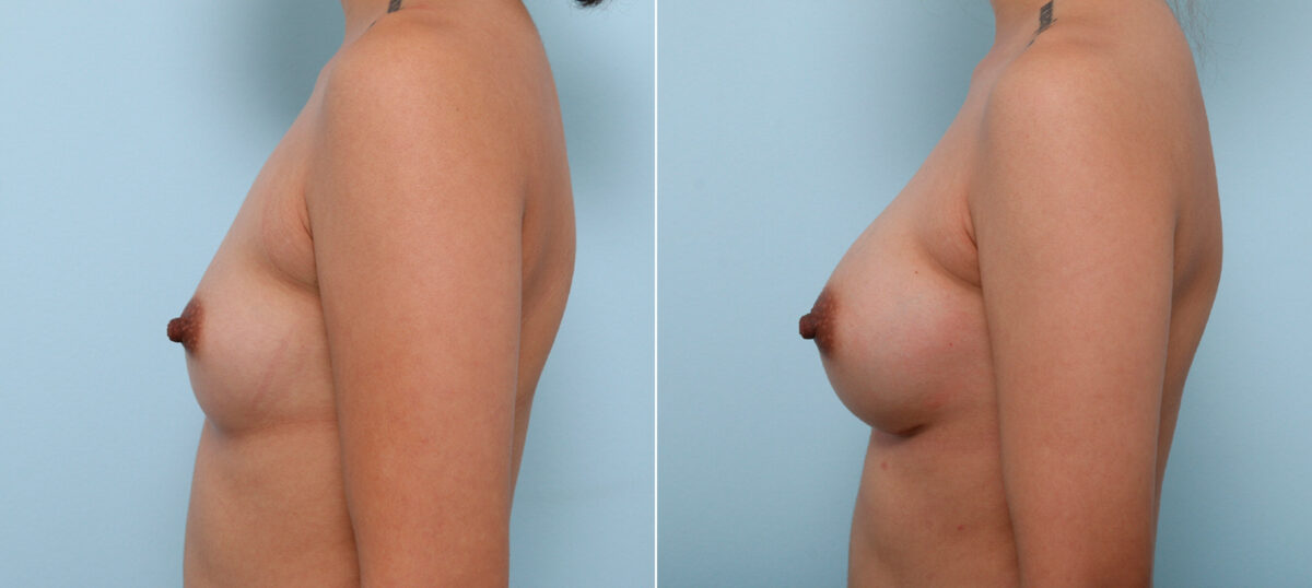 Breast Augmentation before and after photos in Houston, TX, Patient 42434