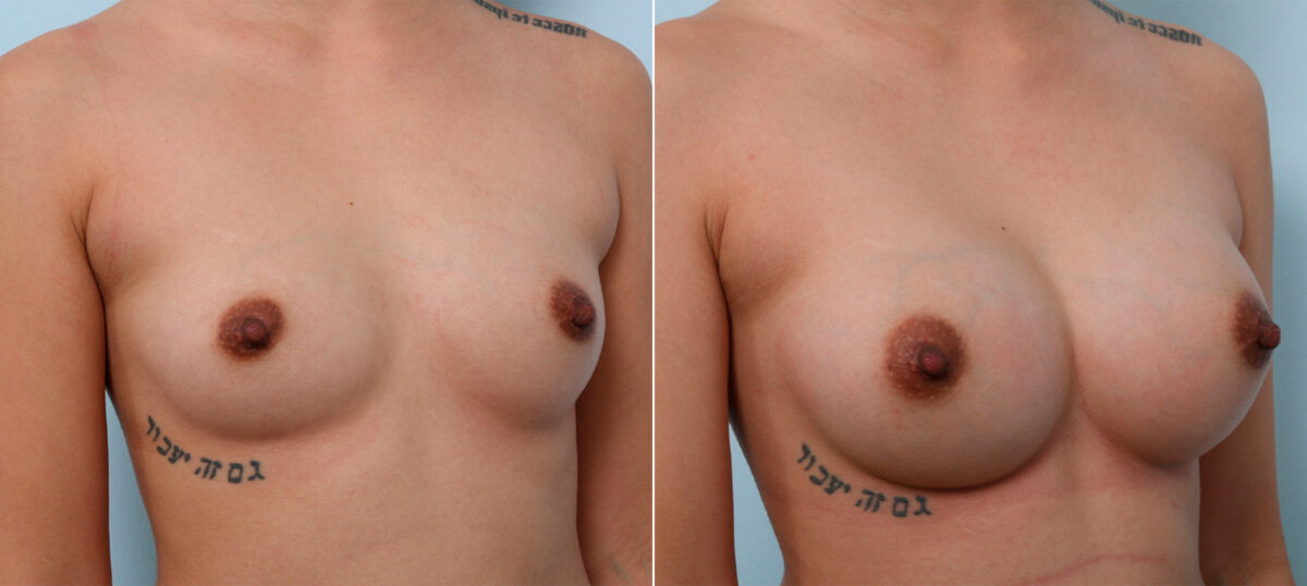 Breast Augmentation before and after photos in Houston, TX, Patient 42434