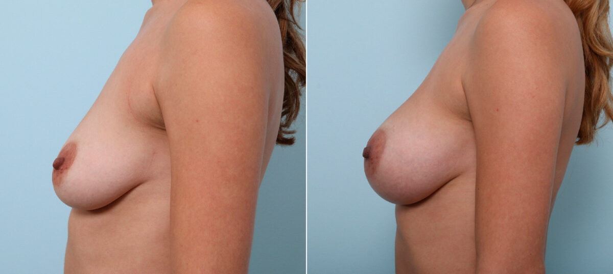 Breast Augmentation before and after photos in Houston, TX, Patient 42455