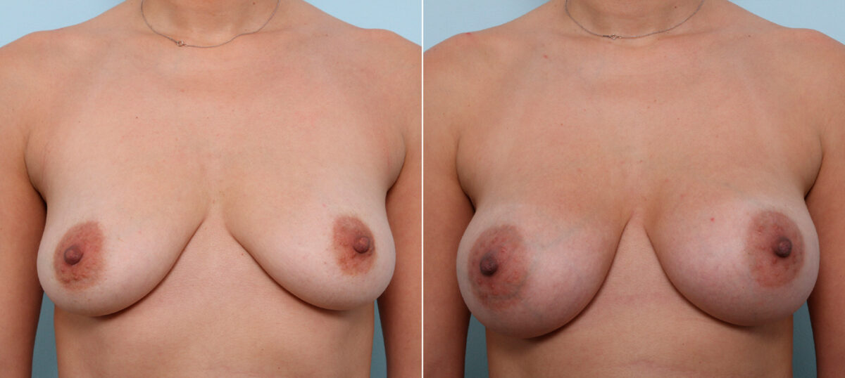 Breast Augmentation before and after photos in Houston, TX, Patient 42455