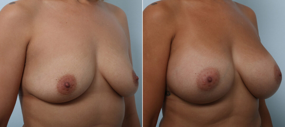 Breast Augmentation before and after photos in Houston, TX, Patient 42472