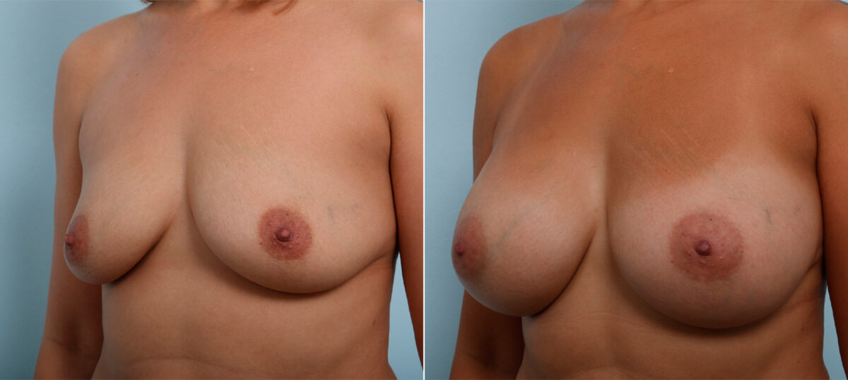 Breast Augmentation before and after photos in Houston, TX, Patient 42472
