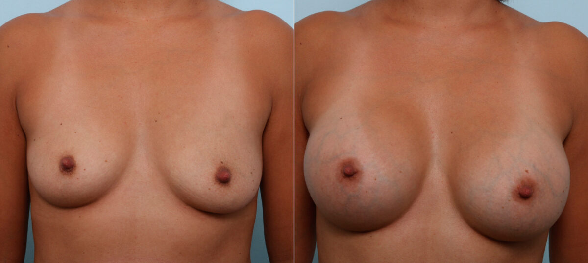 Breast Augmentation before and after photos in Houston, TX, Patient 42493