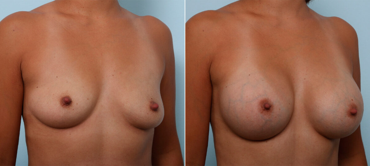Breast Augmentation before and after photos in Houston, TX, Patient 42493