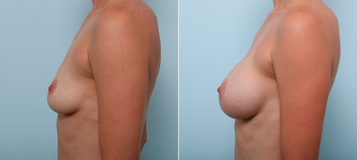 Breast Augmentation before and after photos in Houston, TX, Patient 42514