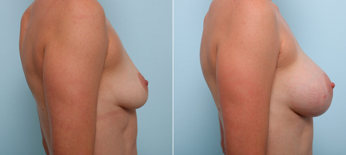 Breast Augmentation before and after photos in Houston, TX, Patient 42514