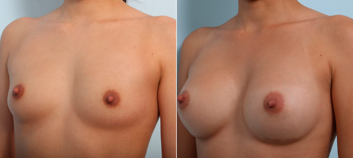 Breast Augmentation before and after photos in Houston, TX, Patient 42535