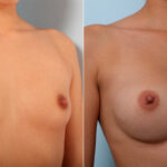 Breast Augmentation before and after photos in Houston, TX, Patient 42535